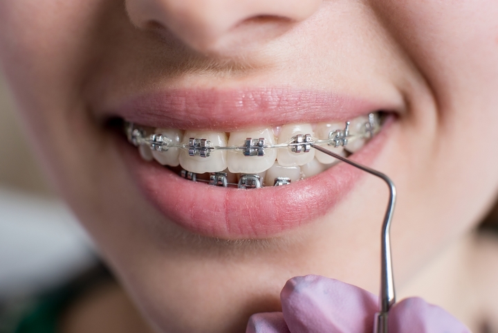 5 Types of Dental Braces for the Millennial Girl